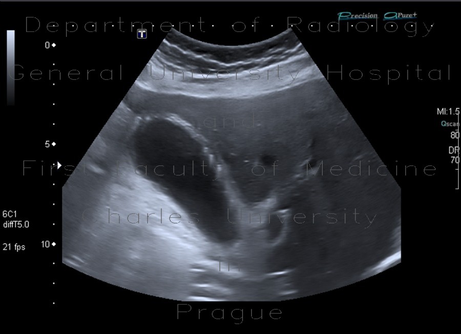 Cholesterolosis of gallbladder