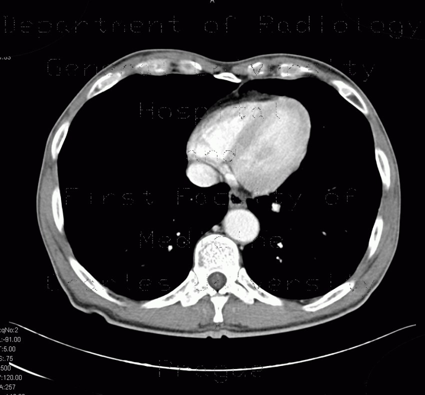 Chondrohamartoma, accidental finding on enterography