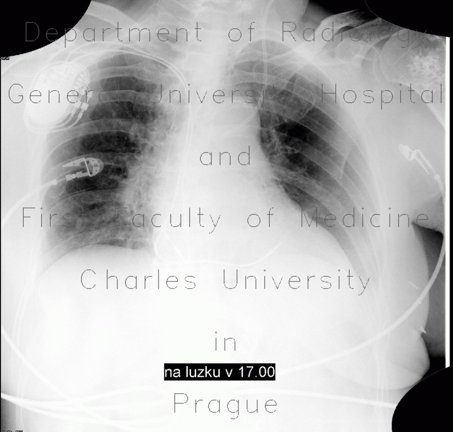 Chondroma of humerus, enchondroma