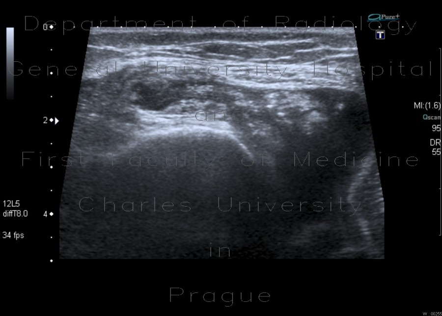 Chondromatosis of knee joint, joint effusion