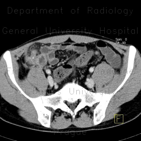Chronic appendicitis, mimic of Crohn's disease, CT enterography