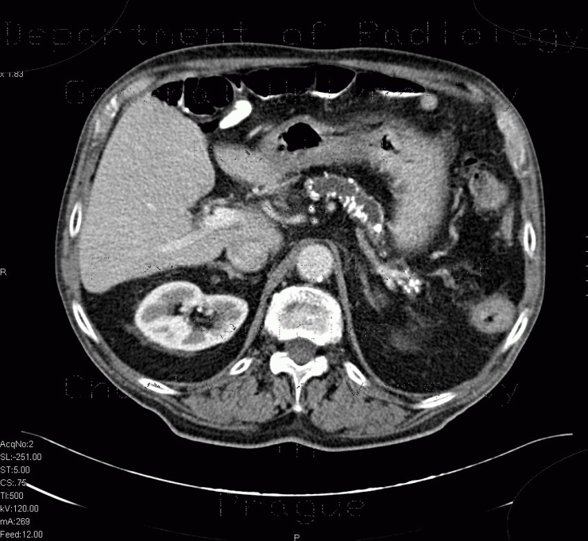 Chronic calcified pancreatitis
