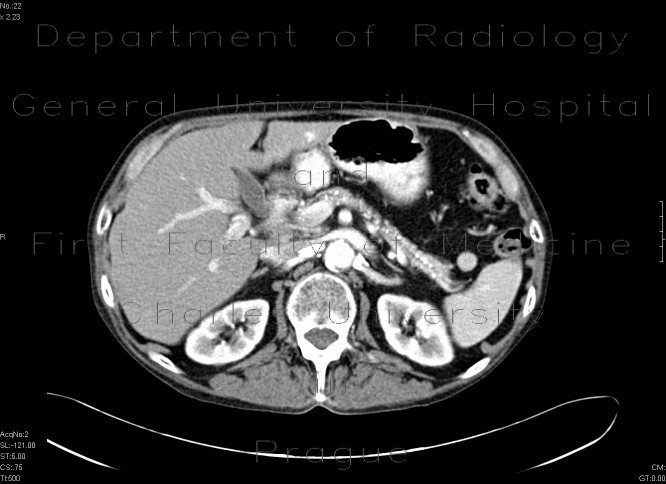 Chronic calcified pancreatitis