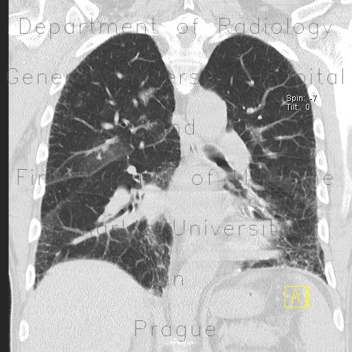 Chronic cardiac insufficiency, Kerley B lines