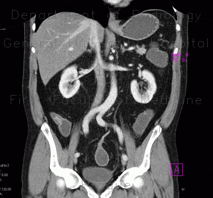 Chronic inflammatory changes of neoterminal ileum