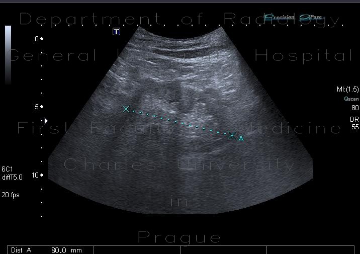 Chronic nephropathy