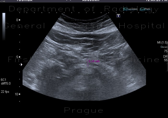 Chronic pancreatitis