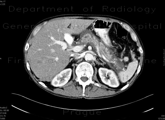 Chronic pancreatitis - acute exacerbation