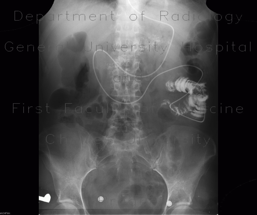 Chronic pancreatitis, calcified, nasojejunal tube