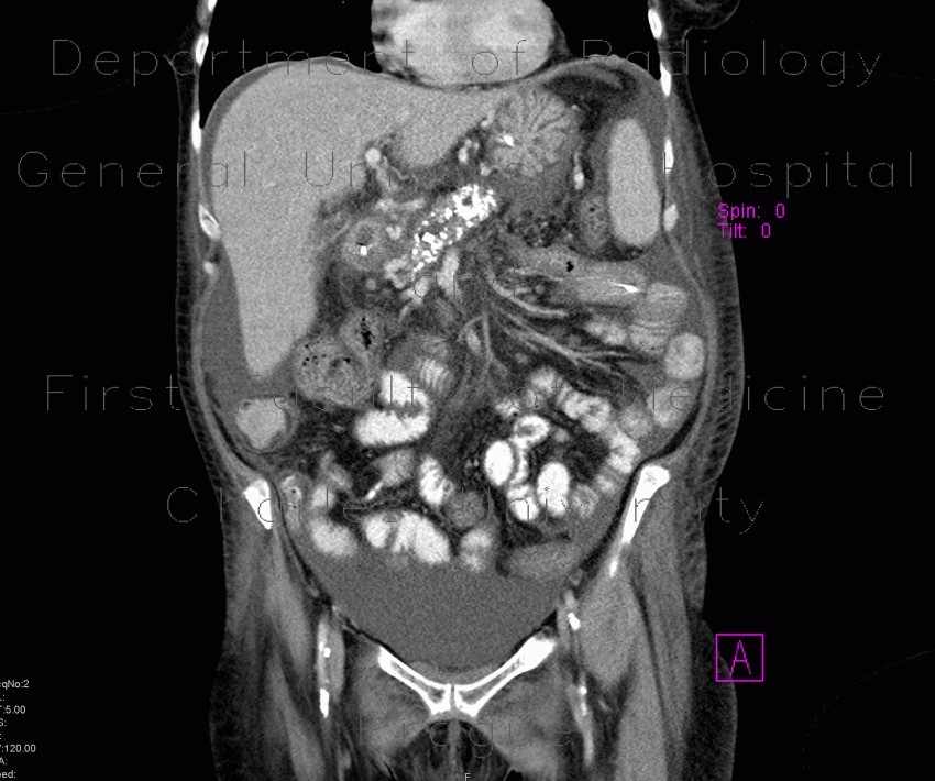 Chronic pancreatitis, dilated pancreatic duct