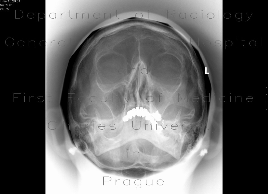 Chronic sinusitis of the left maxillary sinus