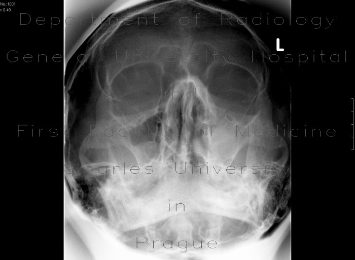 Chronic sinusitis, polyp