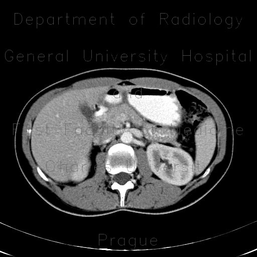 Circumaortic renal vein