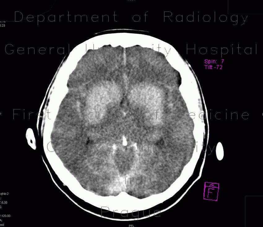 Coagulation necrosis of basal ganglia
