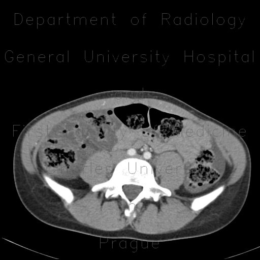 Colitis, acute colitis of the right colon, cecum and ascendens