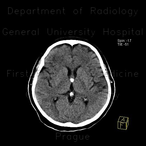 Colloid cyst of the third ventricle