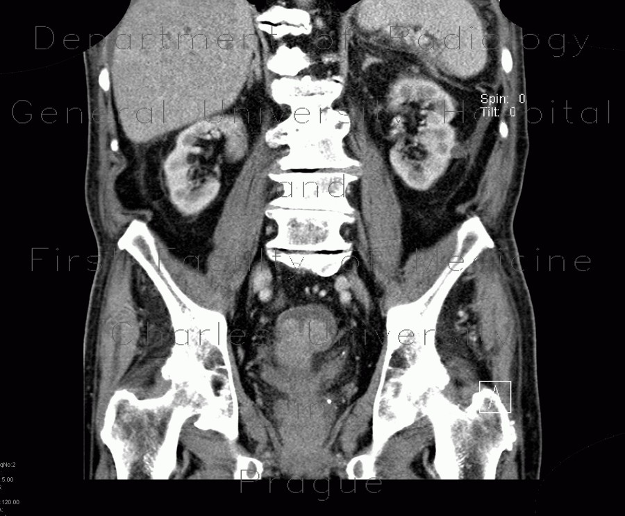 Colorectal cancer, carcinoma of rectum