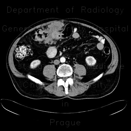 Colorectal cancer, carcinoma of transverse colon, extension in peritoneal cavity and abdominal wall