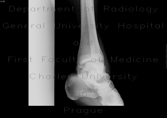 Comminuted fracture of talus
