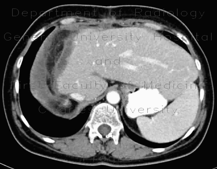 Compensatory enlargement of left liver lobe after resection of right liver lobe
