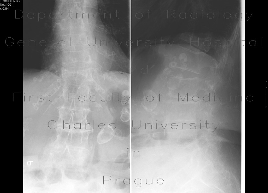 Compression fracture, first lumbar vertebra, osteoporosis