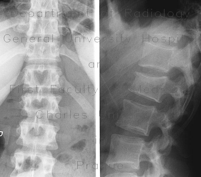 Compression fracture of lumbar vertebra