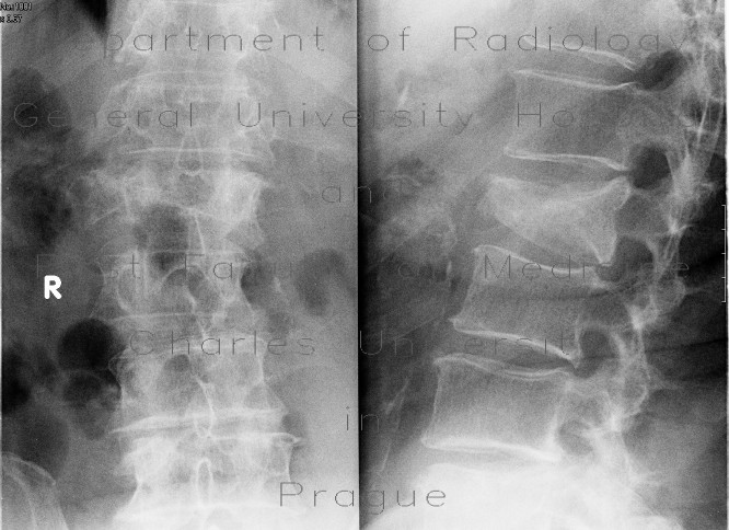 Compression fracture of lumbar vertebra