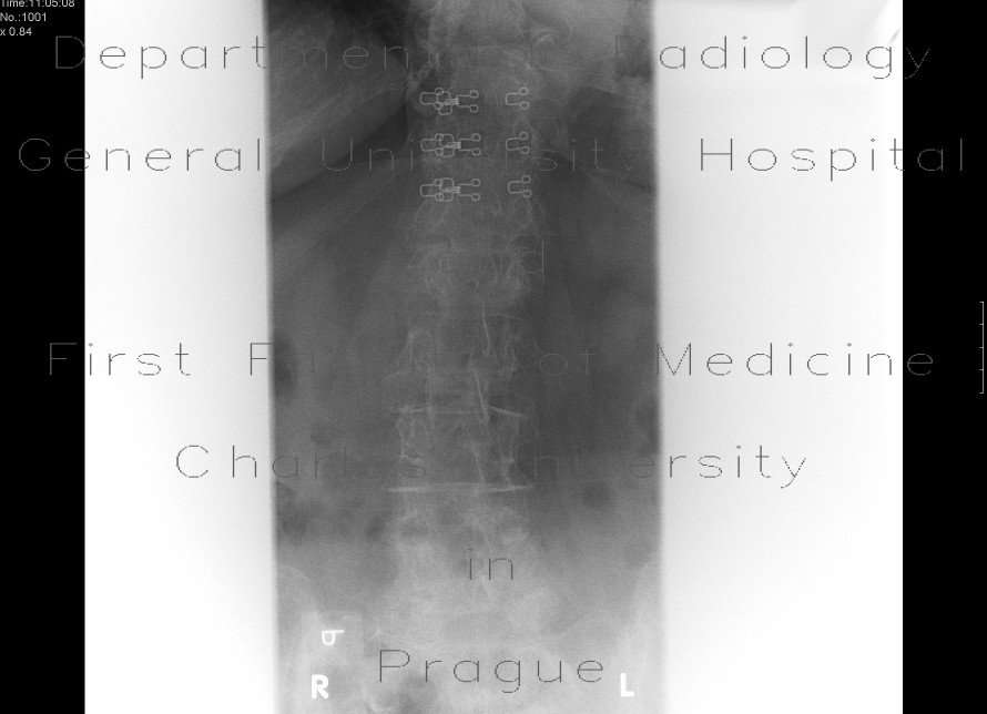 Compression fracture, second lumbar vertebra
