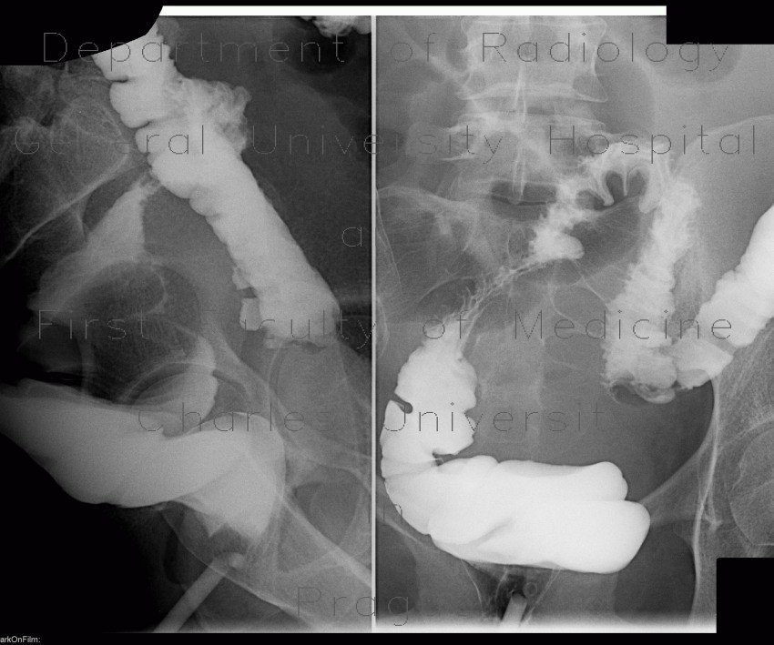 Compression of sigmoid colon