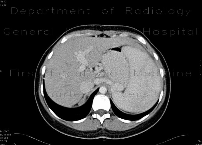 Congenital liver fibrosis, portal hypertension, porto-venous shunts