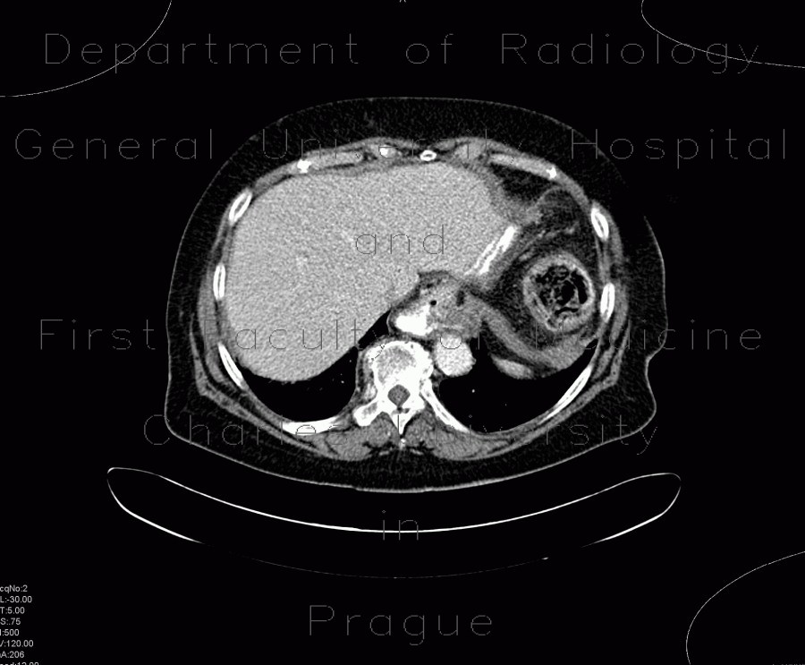 Constipation, large bowel obstruction, low grade