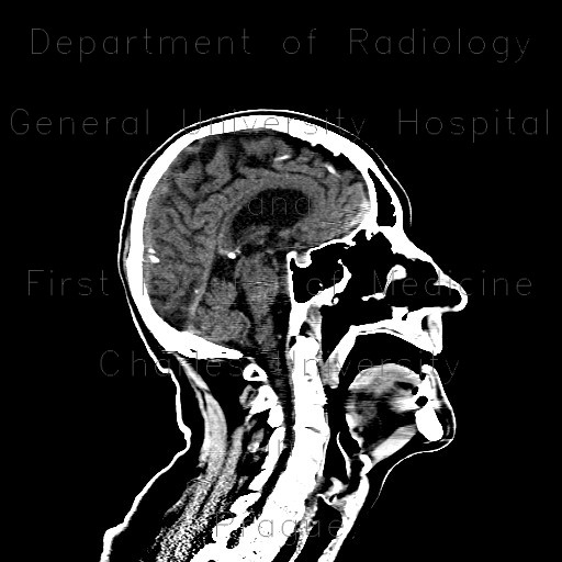 Contusion of frontopolar cortex, beam hardening artifact, subarachonid hemorrhage, initial scan
