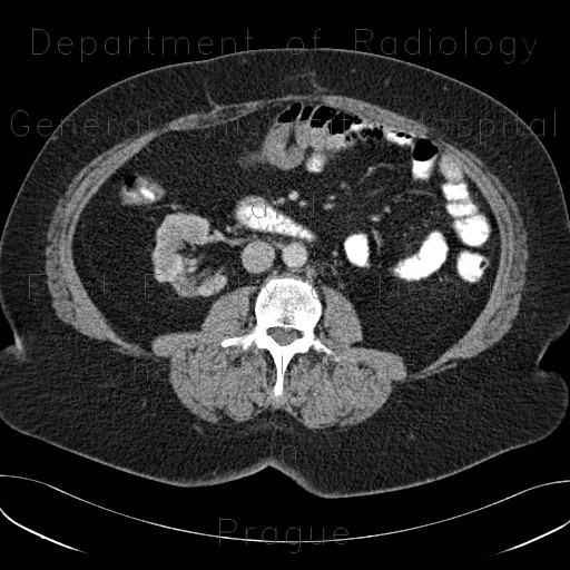 Cortical scars of kidney