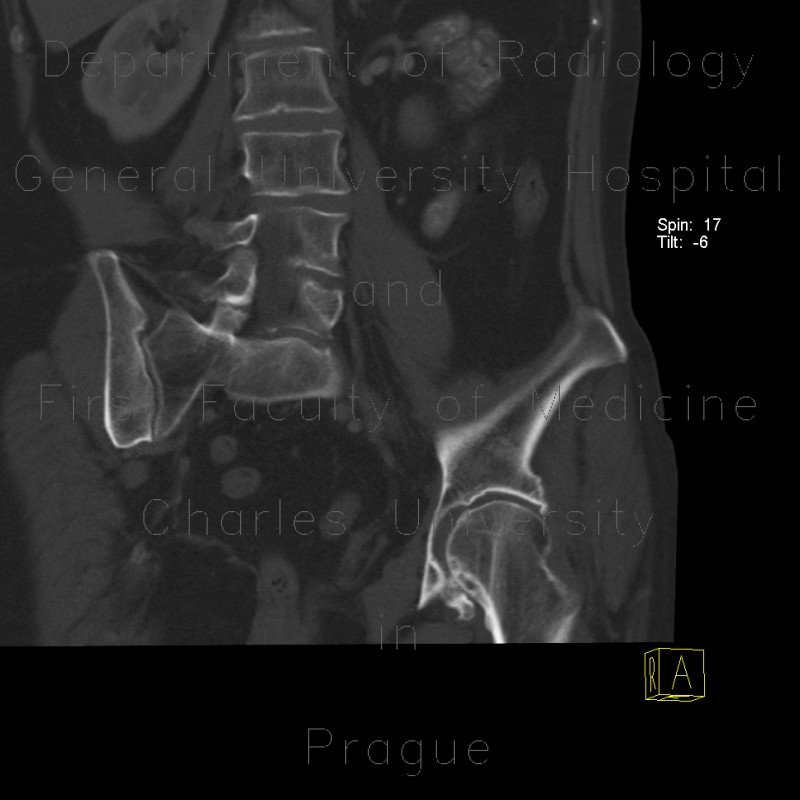 Coxarthrosis, Wiberg's sign