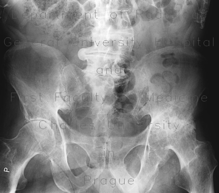Coxarthrosis, severe