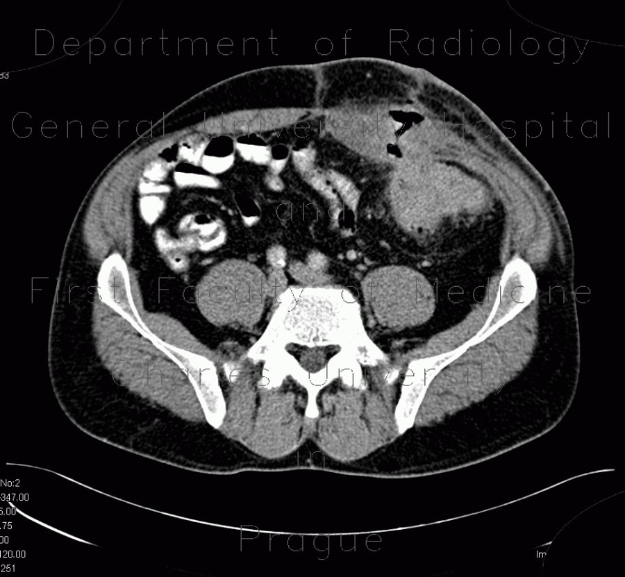 Crohn's disease, fistulising form, fistula in abdominal wall