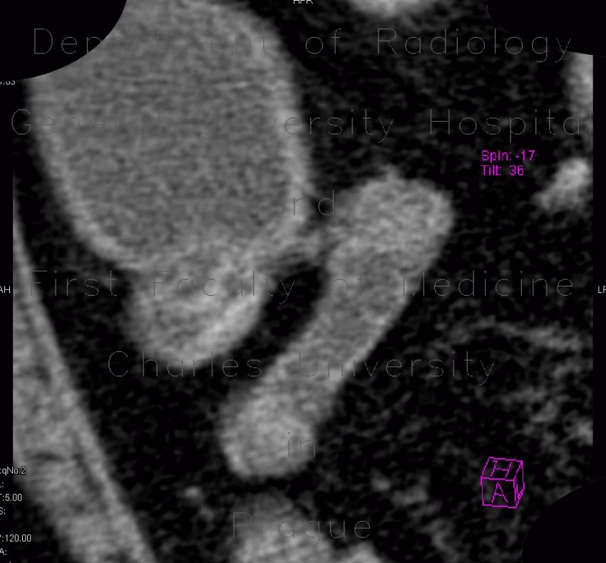Crohn's disease, ileocecal resection, stenosis of anastomosis