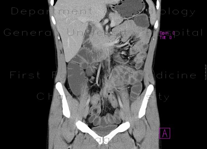 Crohn's disease, intra-abdominal abscess, enterography