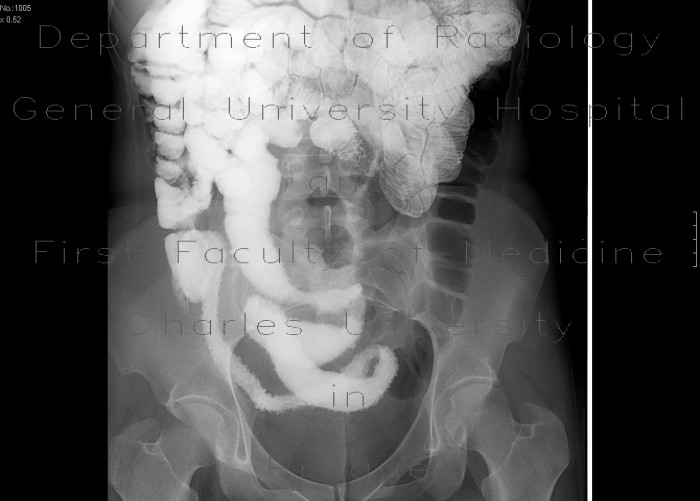Crohn's disease of aboral ileum, enteroclysis