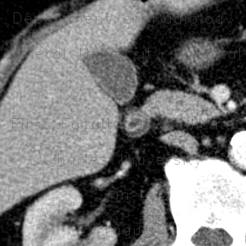 Crohn's disease of duodenum