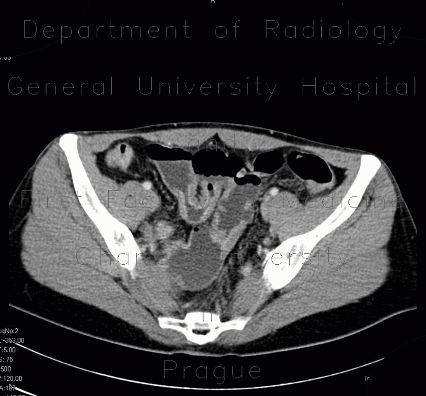 Crohn's disease of ileum, CT enterography
