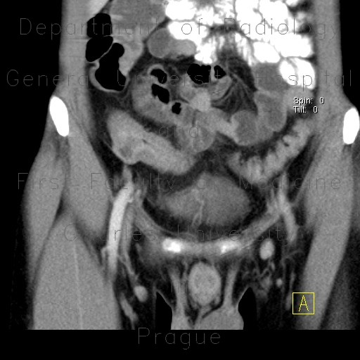 Crohn's disease of neoterminal ileum, abscess