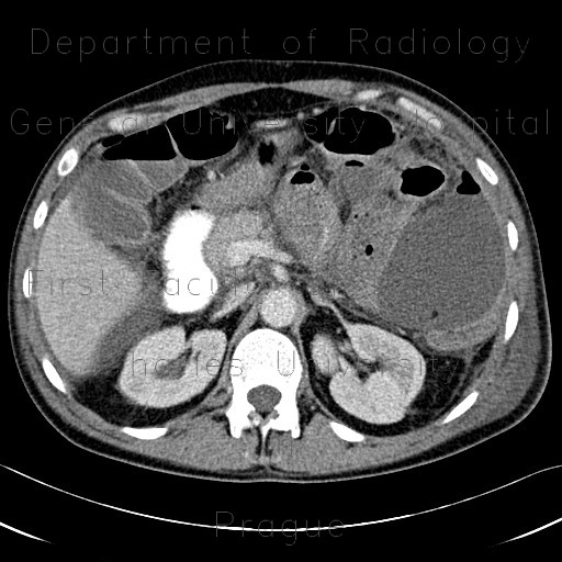 Crohn's disease of small bowel, abdominal abscess