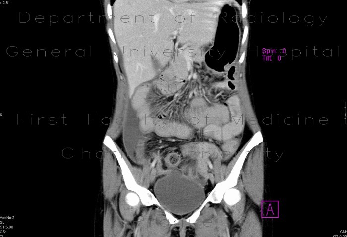 Crohn's disease of terminal ileum, CT, postoperative