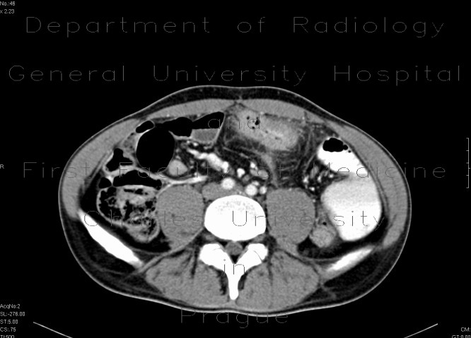 Crohn's disease of the small bowel