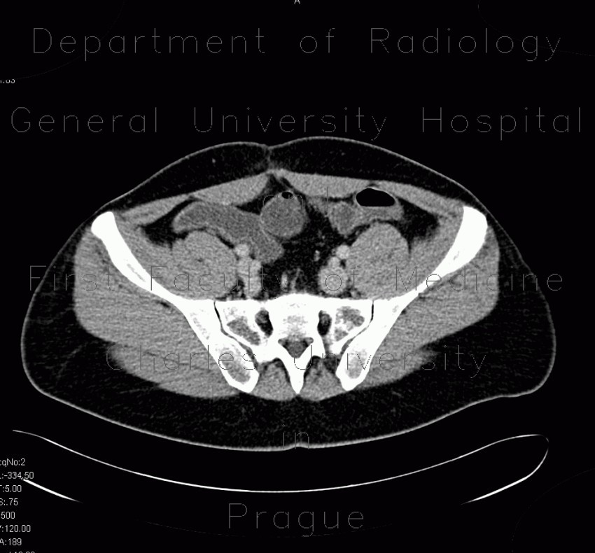 Crohn's disease, postinflammatory changes