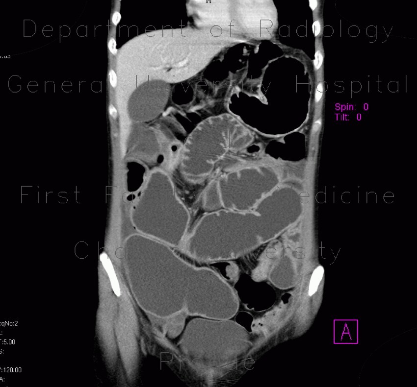 Crohn's disease, stenosis, prestenotic dilatation, CT enteroclysis, first examination