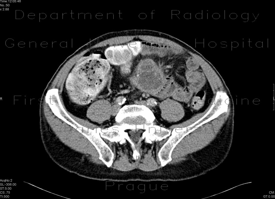 Crohn's disease with abscesses, fistulae, and sacroileitis