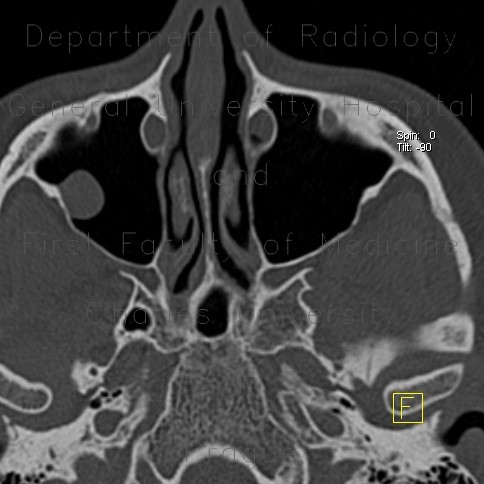 Cyst of maxillary sinus