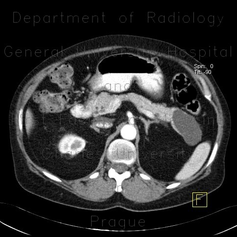 Cystic tumour of pancreas, pancreatic tail